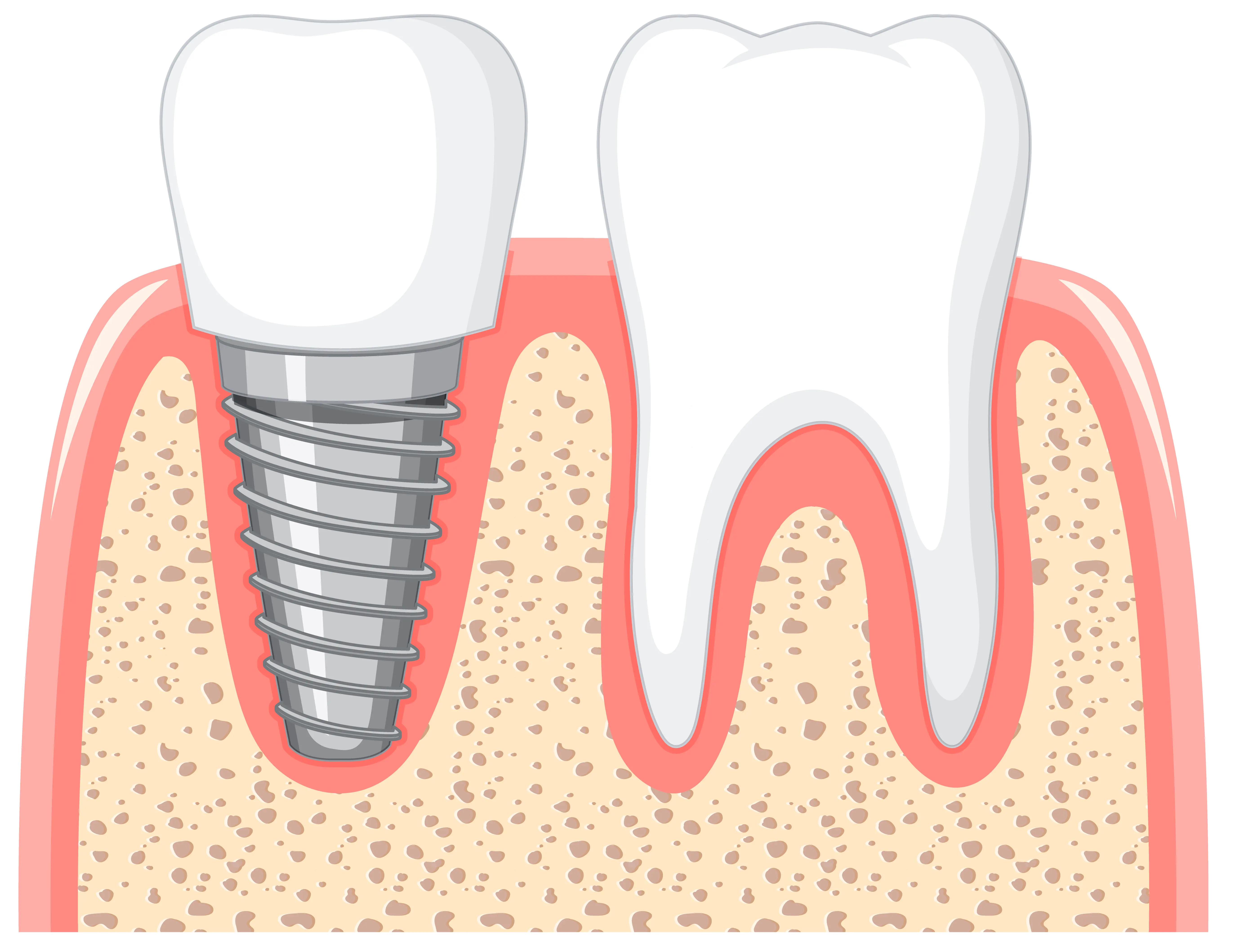 Implantes Dentales